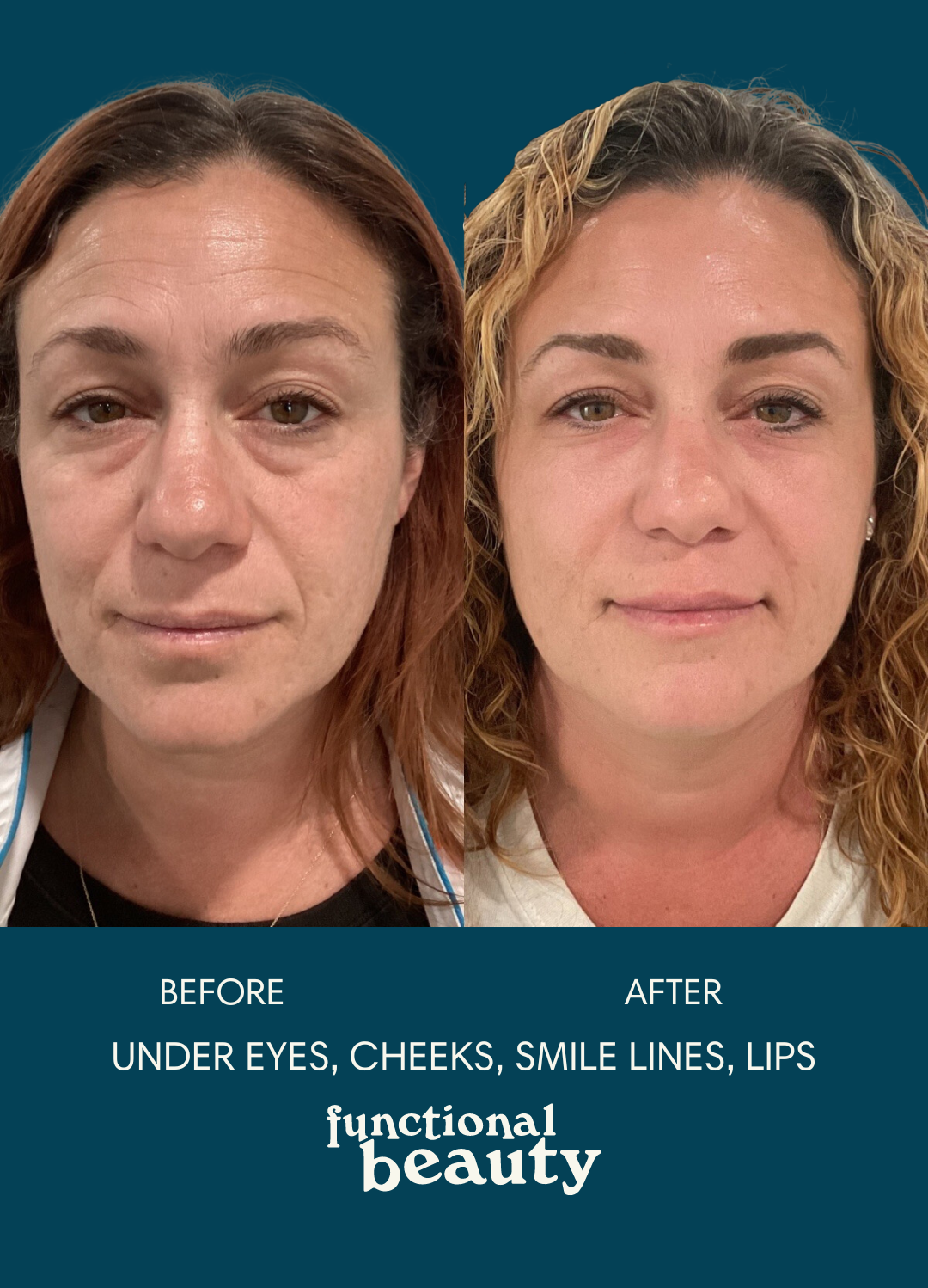 A before and after of a patient treated with dermal filler