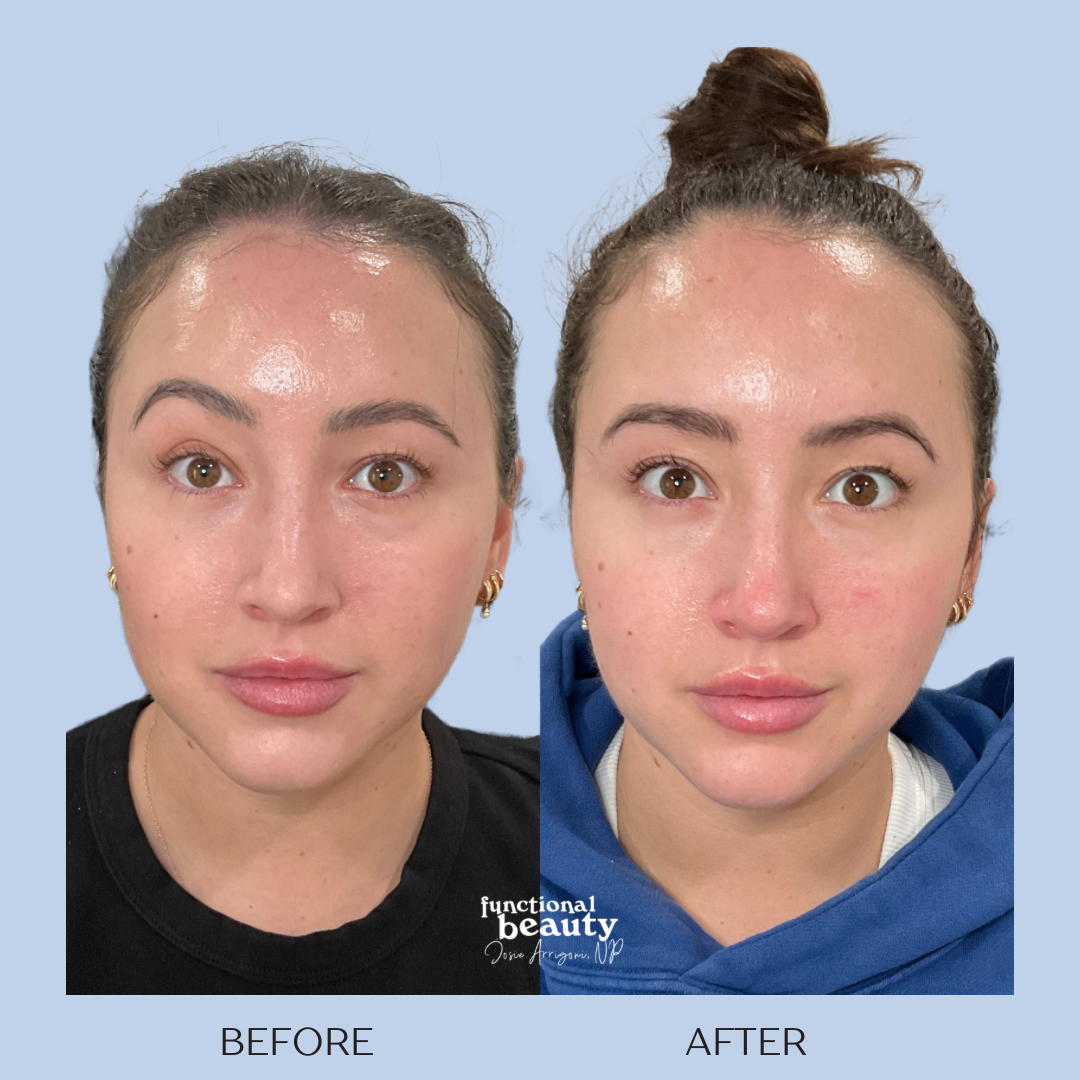 Wrinkle Relaxer used for brow symmetry