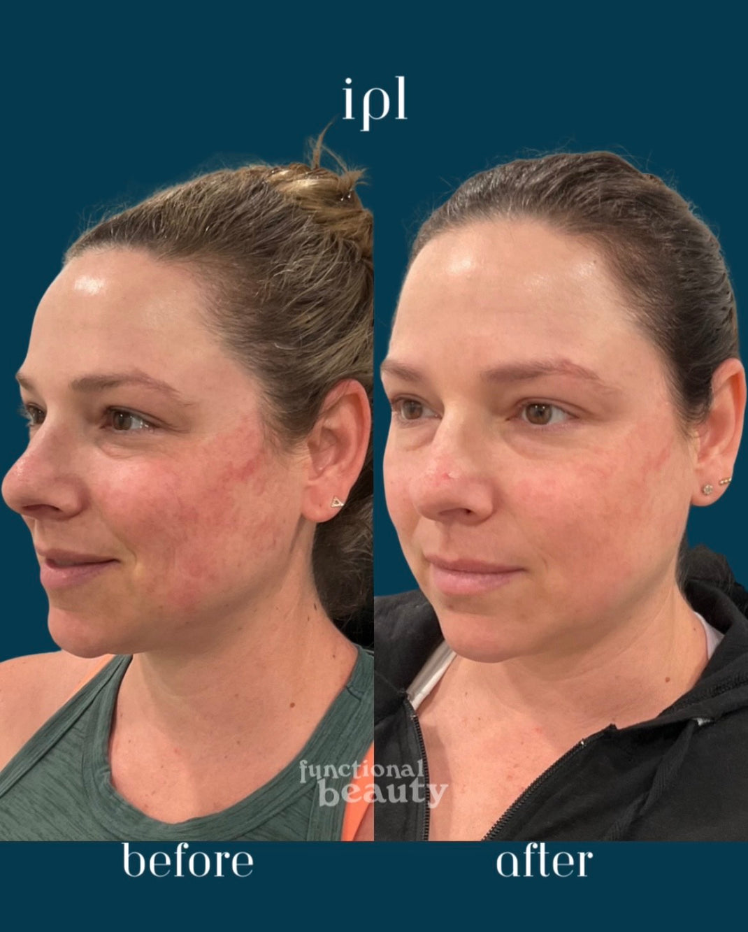 IPL | Enhance Skin Tone & Reduce Pigmentation in Ventura & Moorpark ...