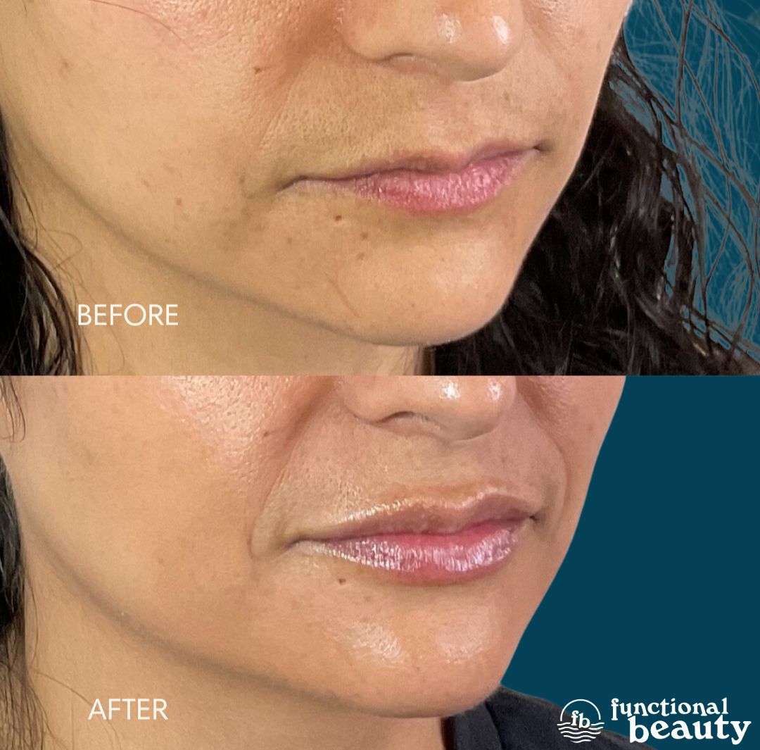 Before and after results of a Signature Lip treatment focusing on lip symmetry and cupid’s bow definition in Ventura, California.