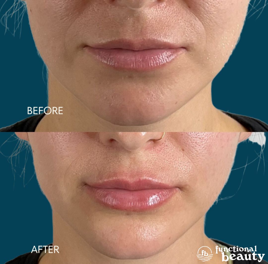 Side-by-side before and after of a Signature Lip enhancement for natural volume and hydration at Functional Beauty in Moorpark.