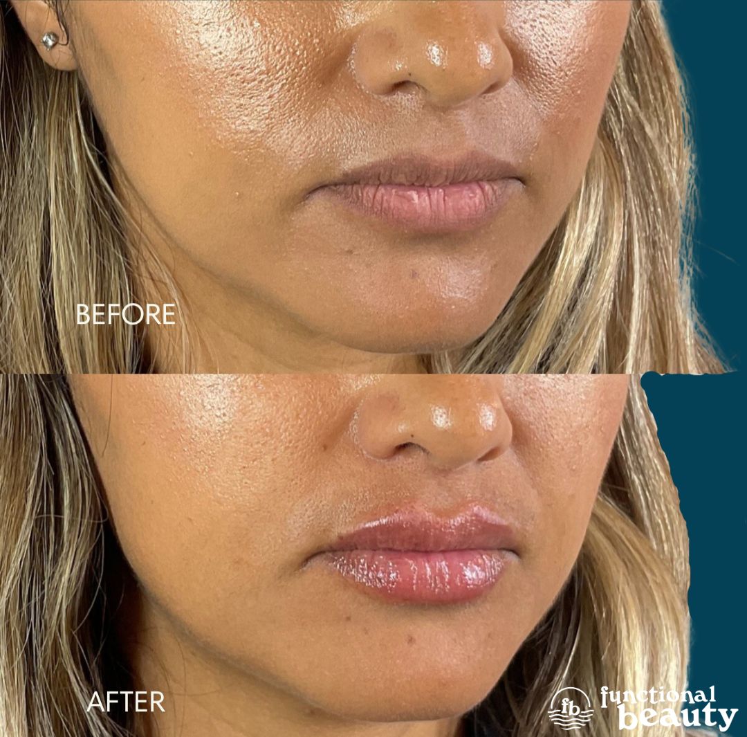 Close-up before and after photo of a Signature Lip filler result showcasing soft tissue integration and a natural-looking result in Ventura County.